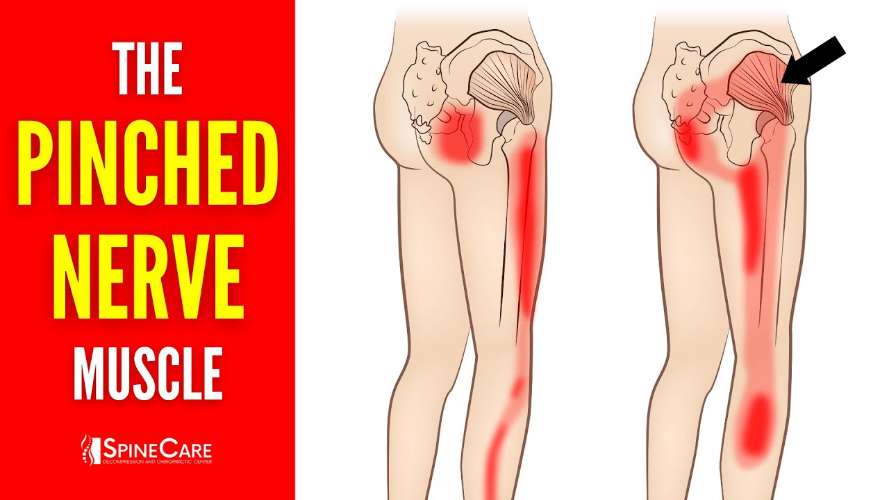 The Pinched Nerve Muscle (How to Release It for INSTANT RELIEF)