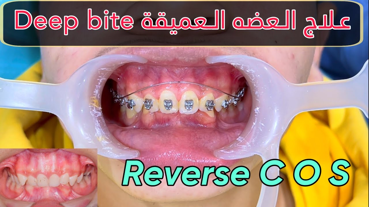 علاج العضه العميقة Deep bite Orthodontic treatment