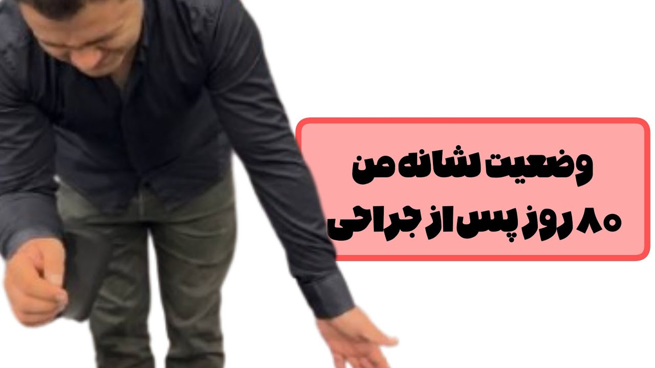 هشتاد روز پس از جراحی مفصل شانه من