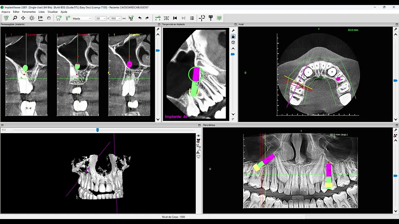 Plano Tangencial no ImplantViewer (176)