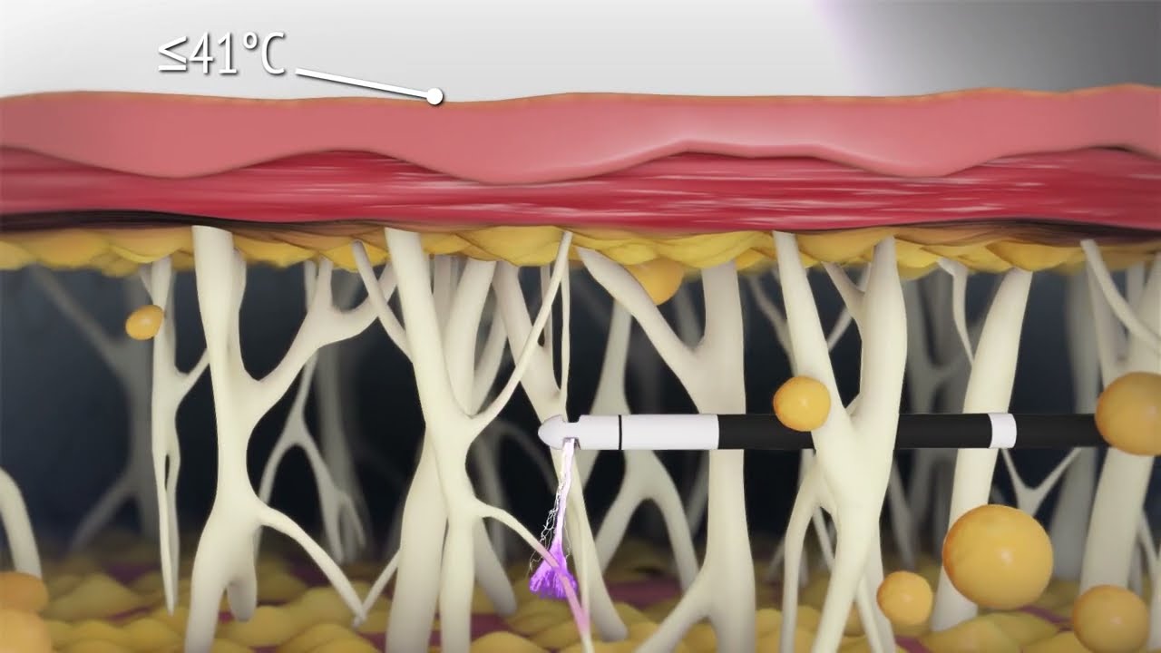 BEVERLY HILLS - HOW PLASMA CAN CHANGE YOUR LIFE? - RENUVION JPLASMA