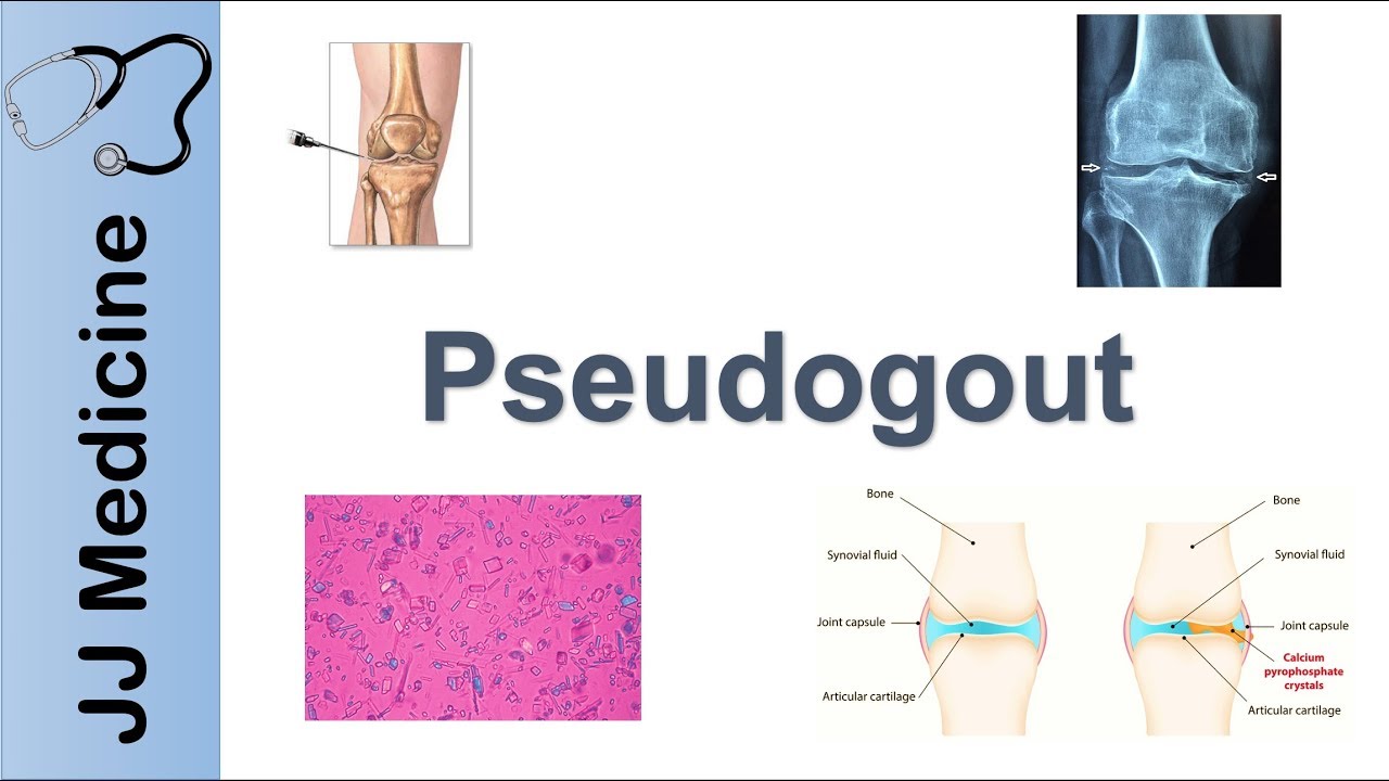 Pseudogout | Pathophysiology, Symptoms and Treatment