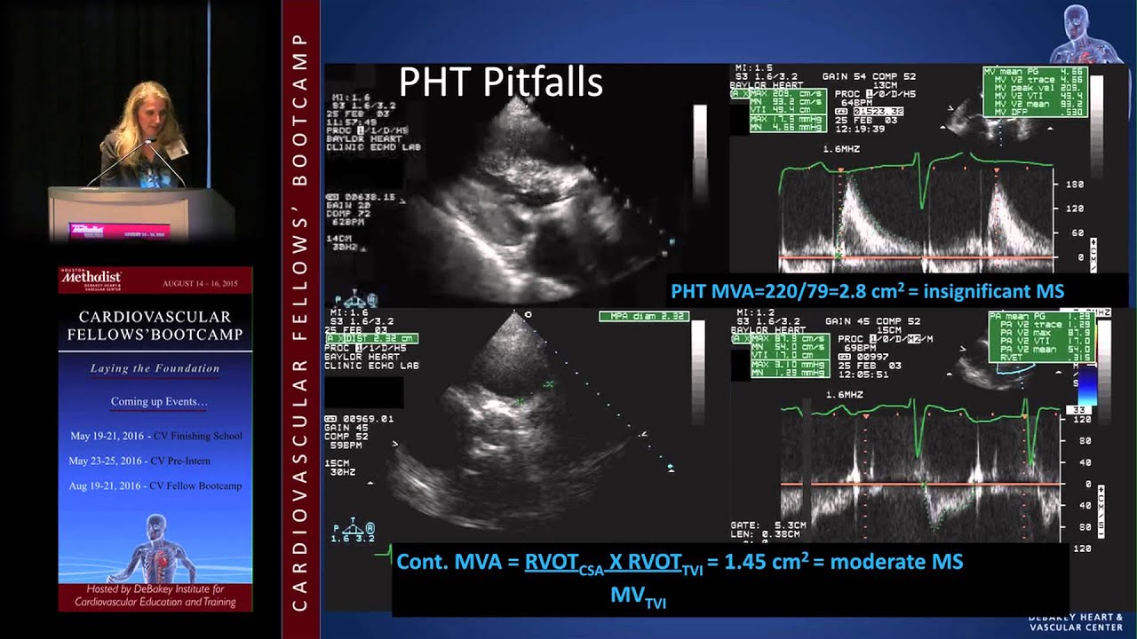 Mitral Stenosis (Karla Kurrelmeyer, MD)