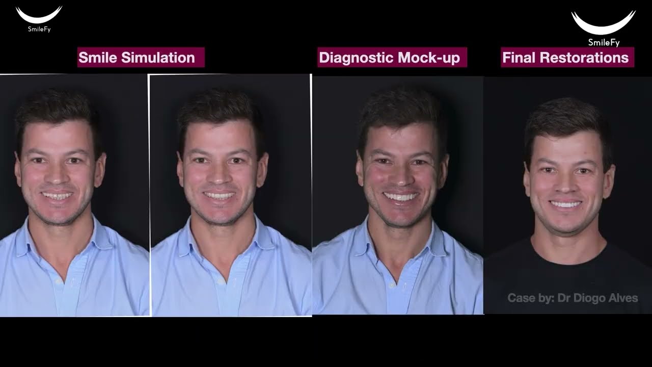How to create an upper and lower in-office 3D Smile design for your patients with Smilefy (Part 1)
