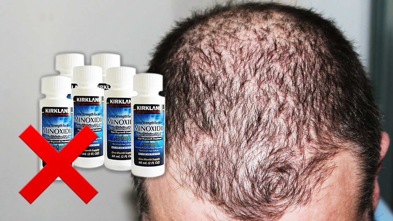 Don't Use MINOXIDIL Before Watching This! – It Does NOT Prevent Hair Loss