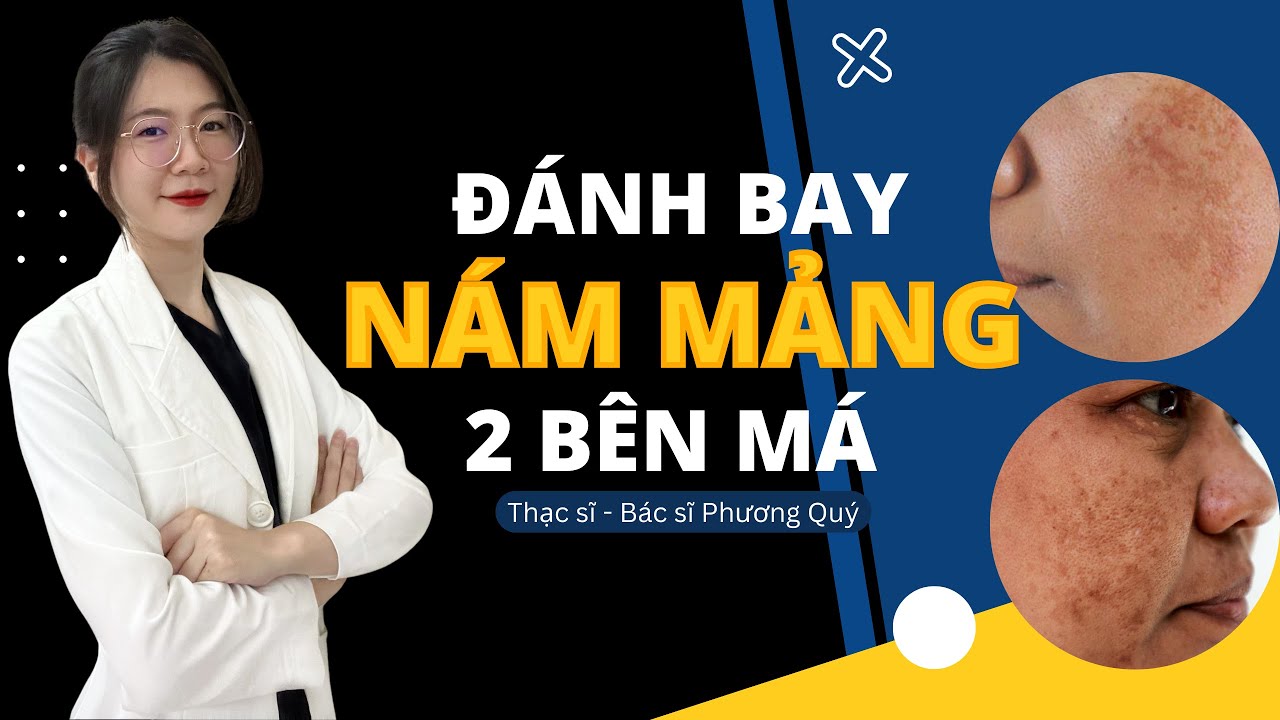 C&aacute;ch trị N&Aacute;M MẢNG 2 b&ecirc;n G&Ograve; M&Aacute; | Thạc sĩ - B&aacute;c sĩ Phương Qu&yacute;