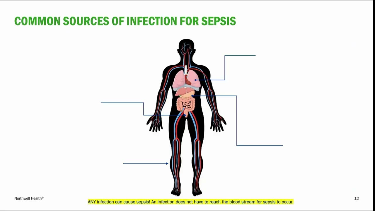 NSUH Nursing Grand Rounds 2025: Improving Sepsis Outcomes: A Multidisciplinary Approach
