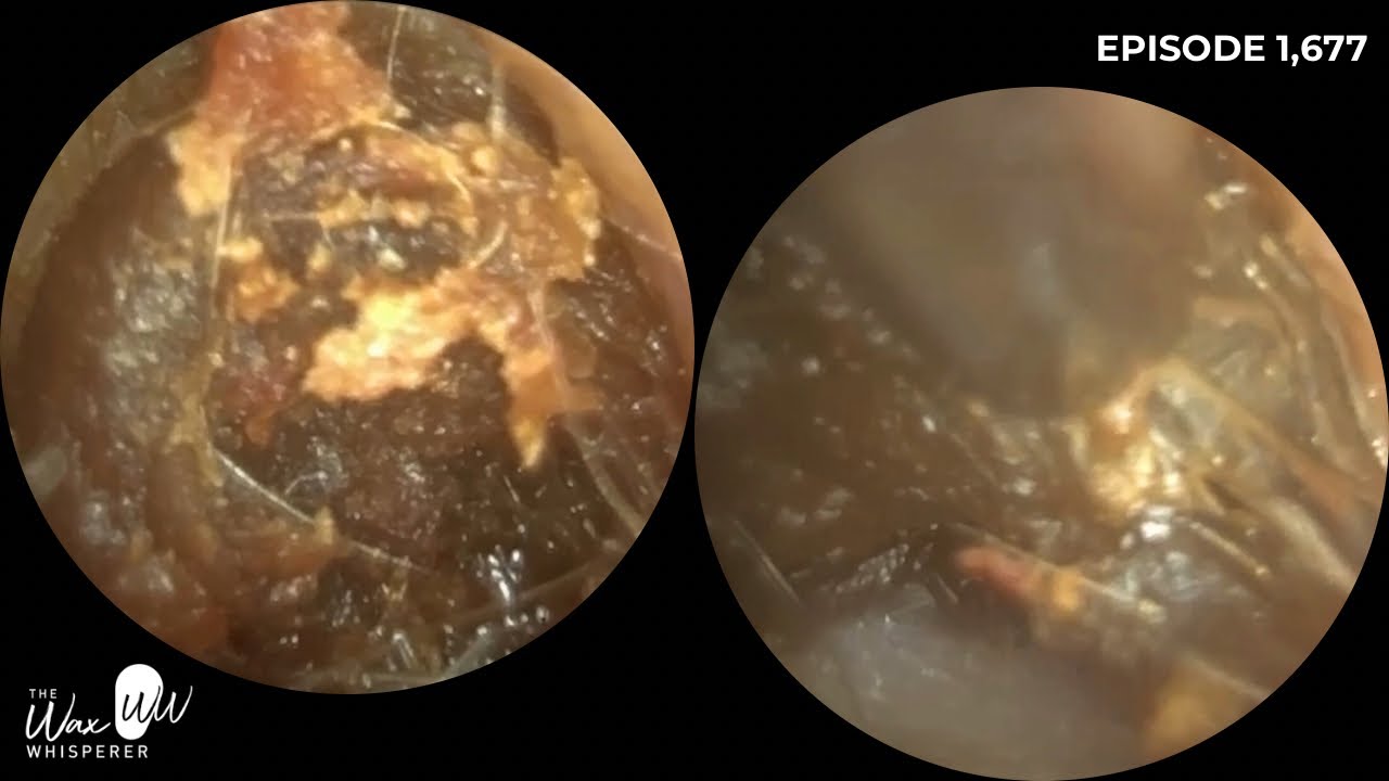 1,677 - Wax Plug & Dead Skin Extraction | Endoscopic Ear Wax Removal