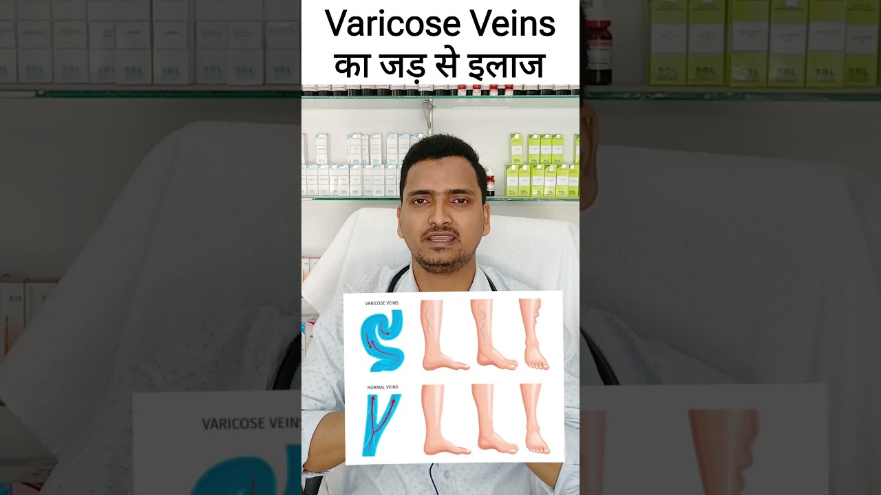 Varicose veins treatment without surgery |spider veins homeopathic treatment|varicose veins ka ilaj