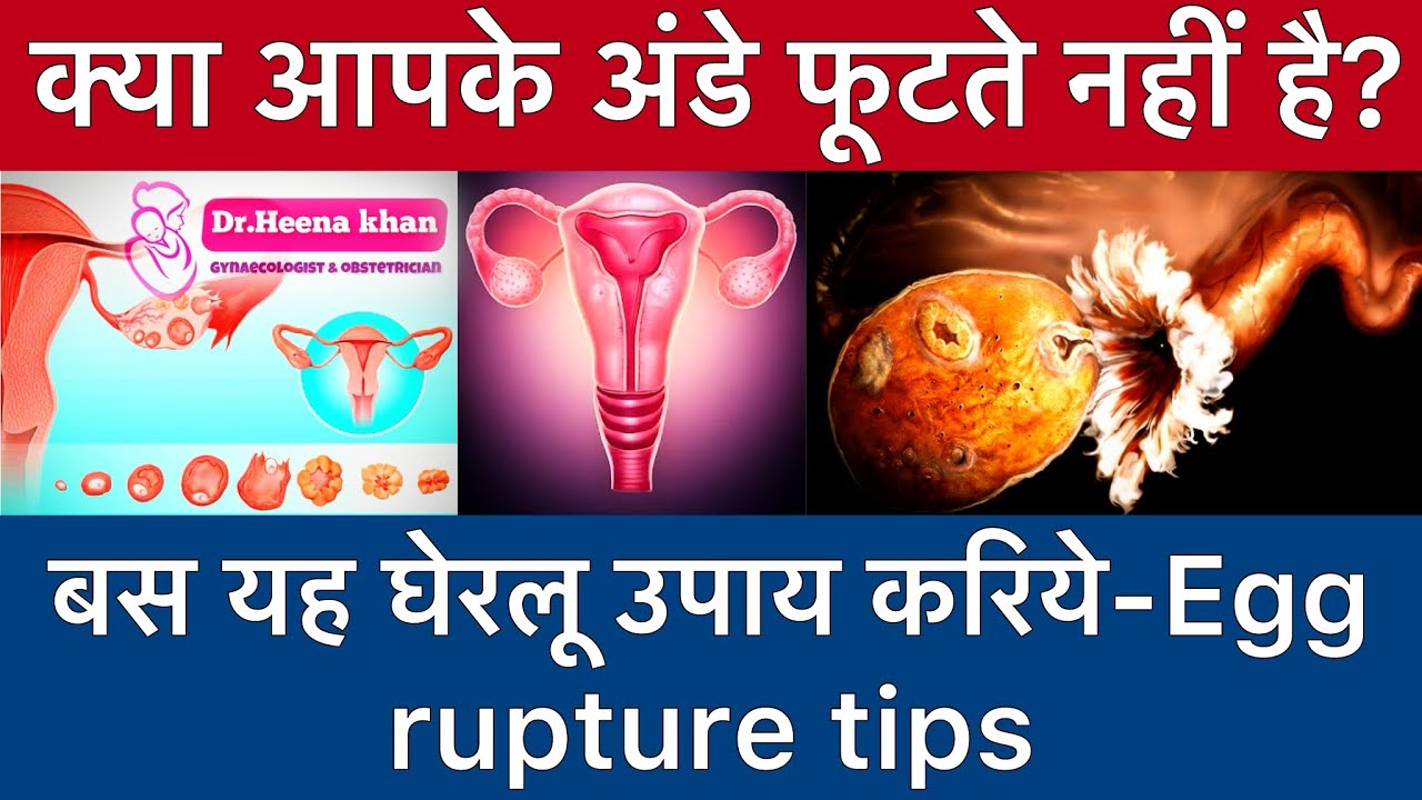 क्या आपके अंडे फूटते नहीं है।बस यह घेरलू उपाय करिये-Egg rupture tips-DrHeenaKhanGynecologist