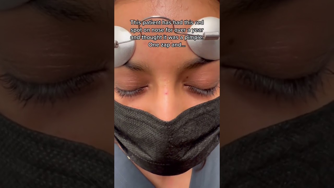 This is the laser you want if you have red spots, rosacea, blood vessels you want to target #shorts