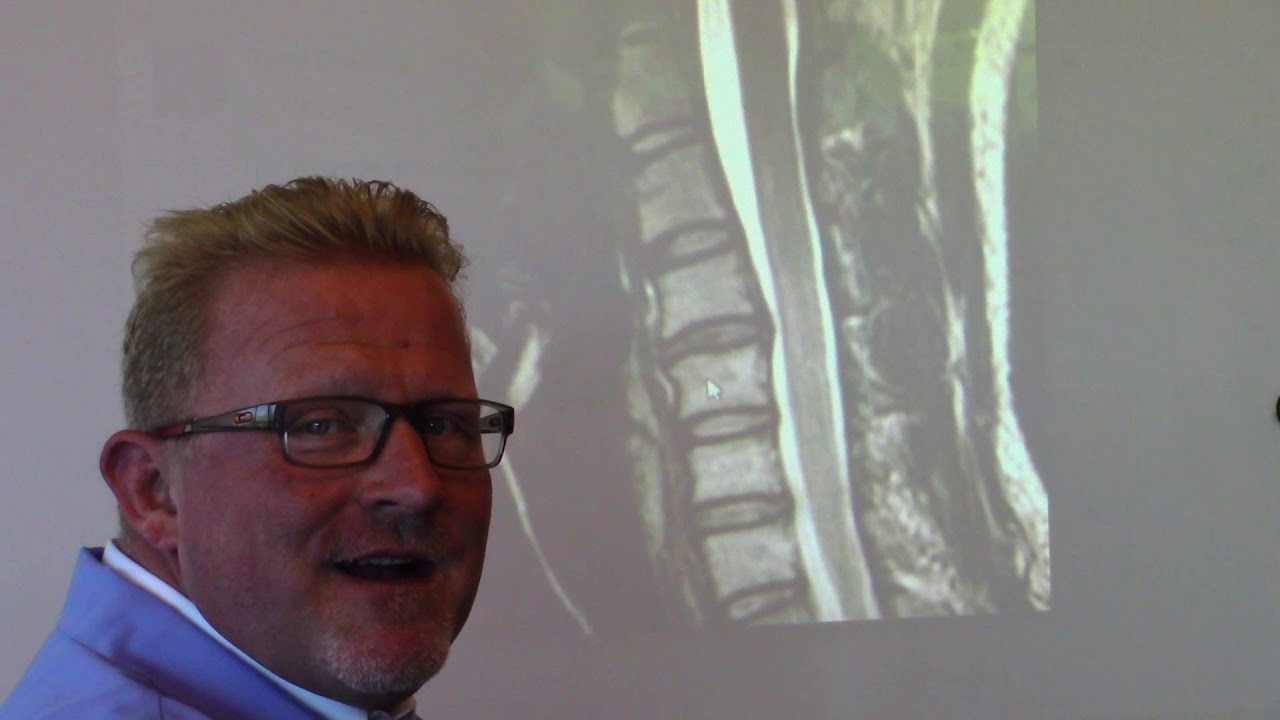 MRI of Spine - Numbness, Loss Of Sensation In Arm
