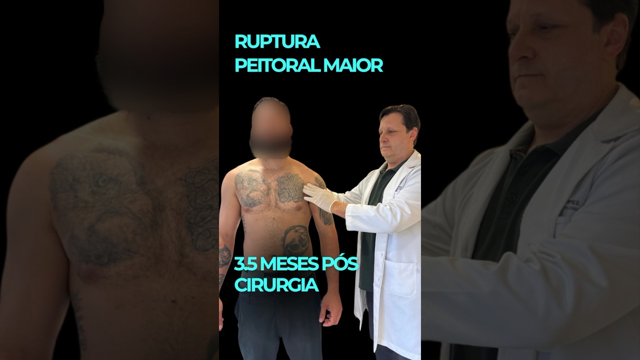 Ruptura do Peitoral maior. 3,5 meses de cirurgia.  #peitoral #gabrielmedina  #hafthorbjornsson