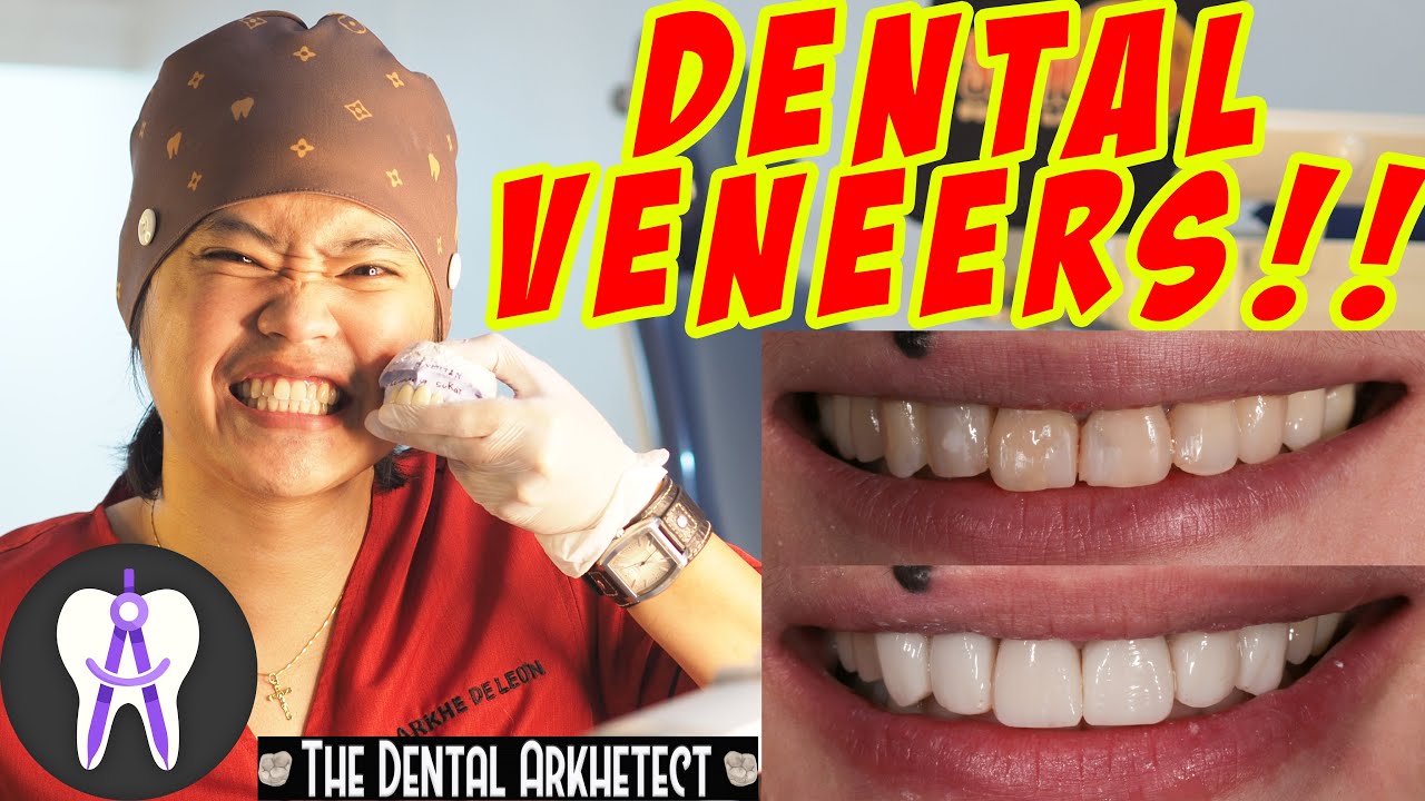 Dental Veneer? Direct at Indirect Veneer. Mga Dapat Malaman. 