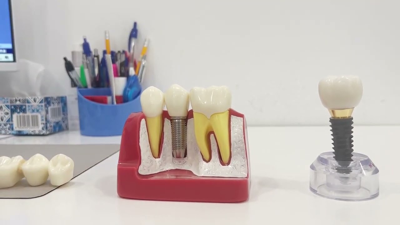 Dentální implantáty - zubní náhrada