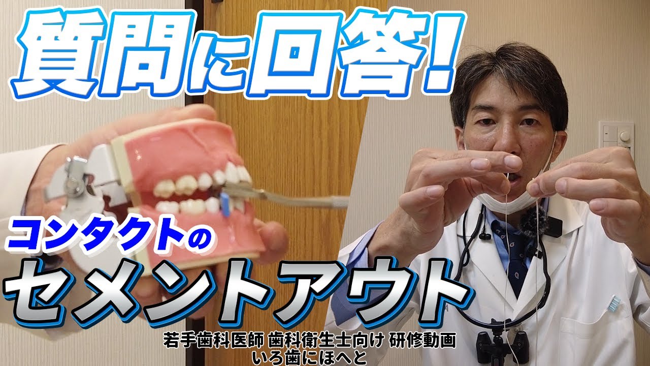 【余剰セメントの除去】セット後にフロスが通らない？コンタクトのセメントアウトについて