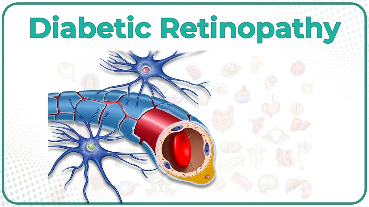 Diabetic Retinopathy Animation : Pathogenesis, Classification, Diagnosis, Treatment & Complications