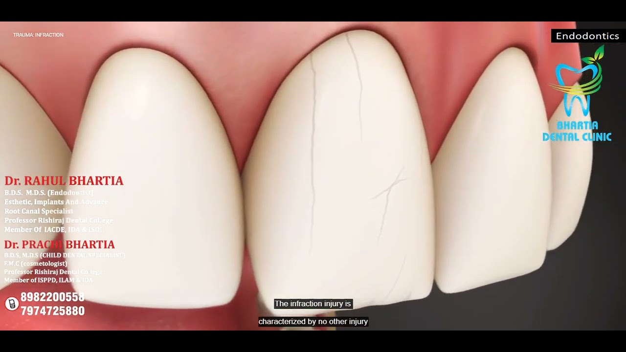 Understanding Infractions :Dental Enamel Injuries - Bhartia Dental Clinic