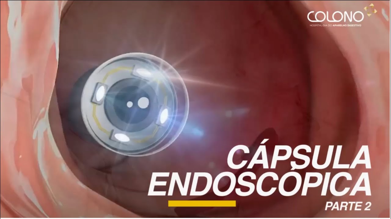 Cápsula Endoscópica na Colono -  Parte 2