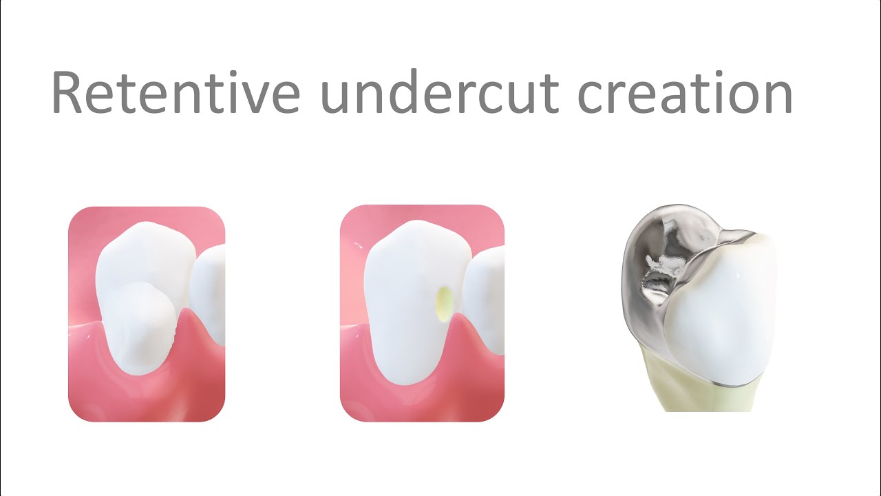 Retentive Undercut creation(surveyed crowns) for RPD in 2 mins
