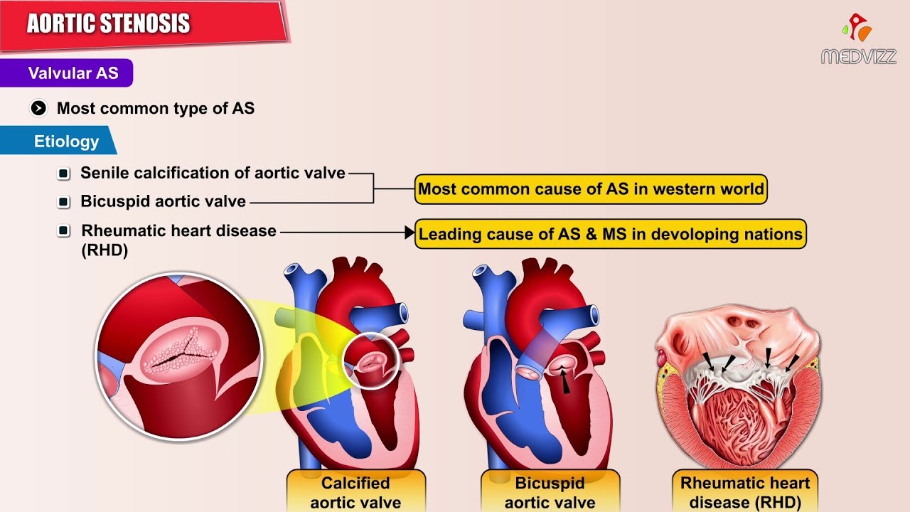 Aortic Stenosis  - Causes , Symptoms , Pathology , Diagnosis and Treatment