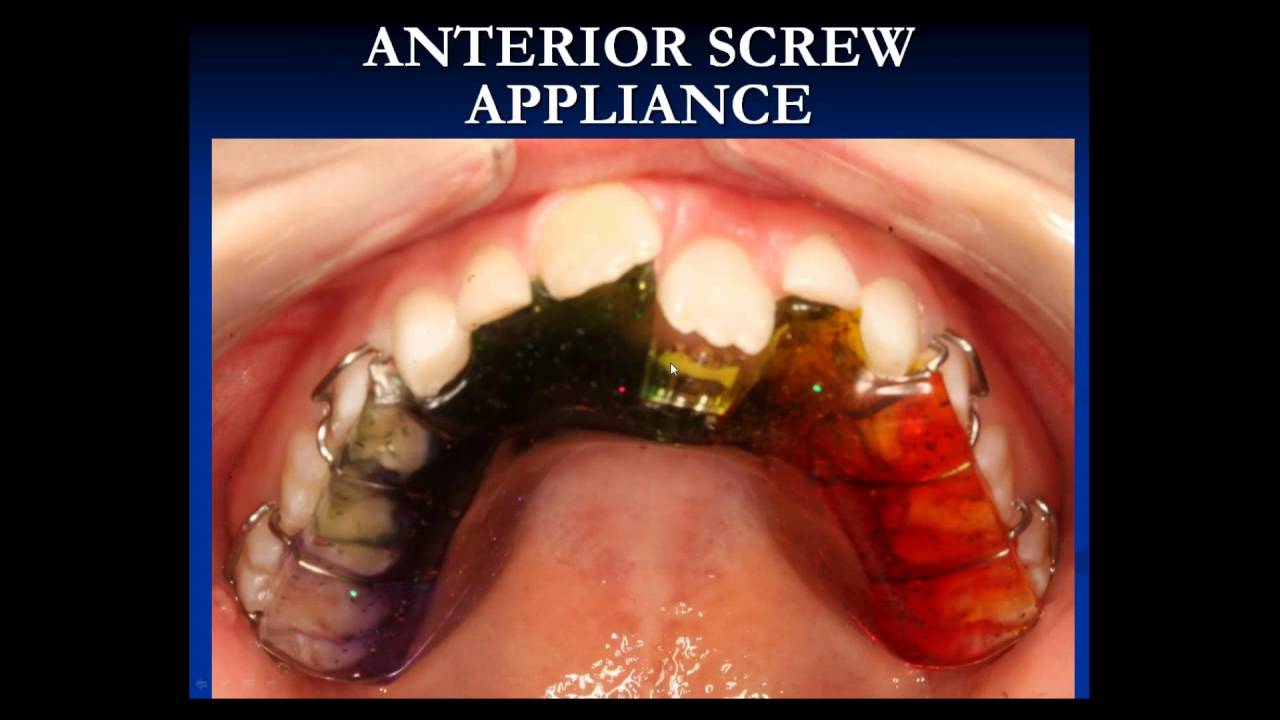 How Early Orthodontic Treatment can Improve the Overall Health of the Patient by Dr. Rondeau