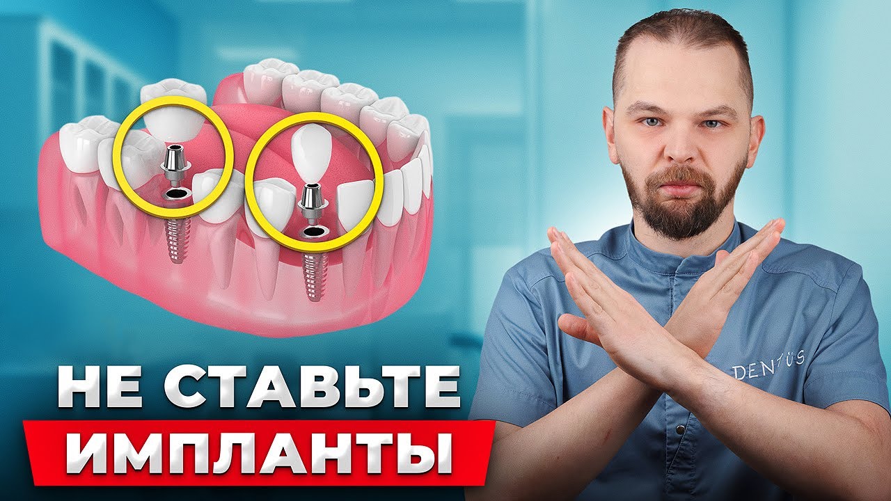 Не ставьте импланты пока не посмотрите это видео!