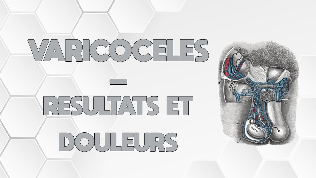 LES VARICOCÈLES - DOULEURS ET RESULTATS