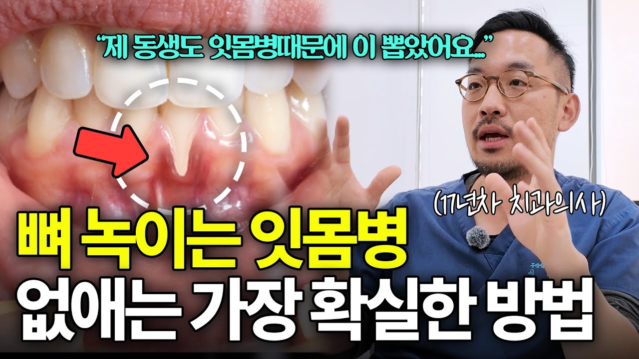 “제 동생도 잇몸병때문에 발치했어요…“ l 방치하면 무조건 발치! 잇몸병 없애는 가장 확실한 방법