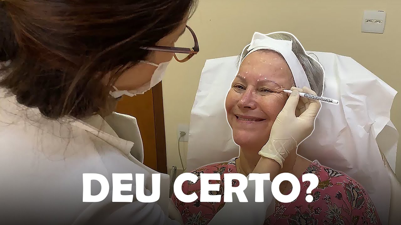 APLIQUEI BOTOX NO ROSTO! 😱| CASAL20