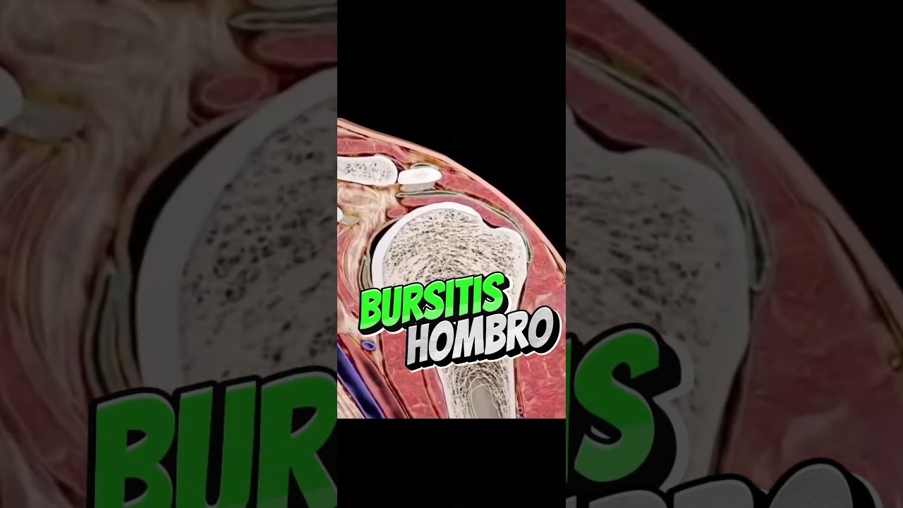 ✅&iquest;C&oacute;mo se forma la bursitis del hombro?✅ #fisio #osteopatia #bursa #tendinitis #hombro