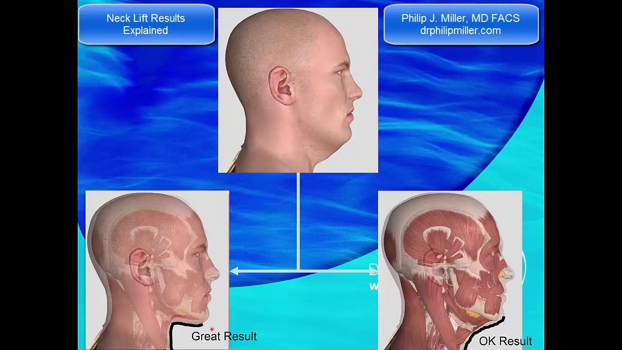 Neck Lift Results Explained for NYC Patients