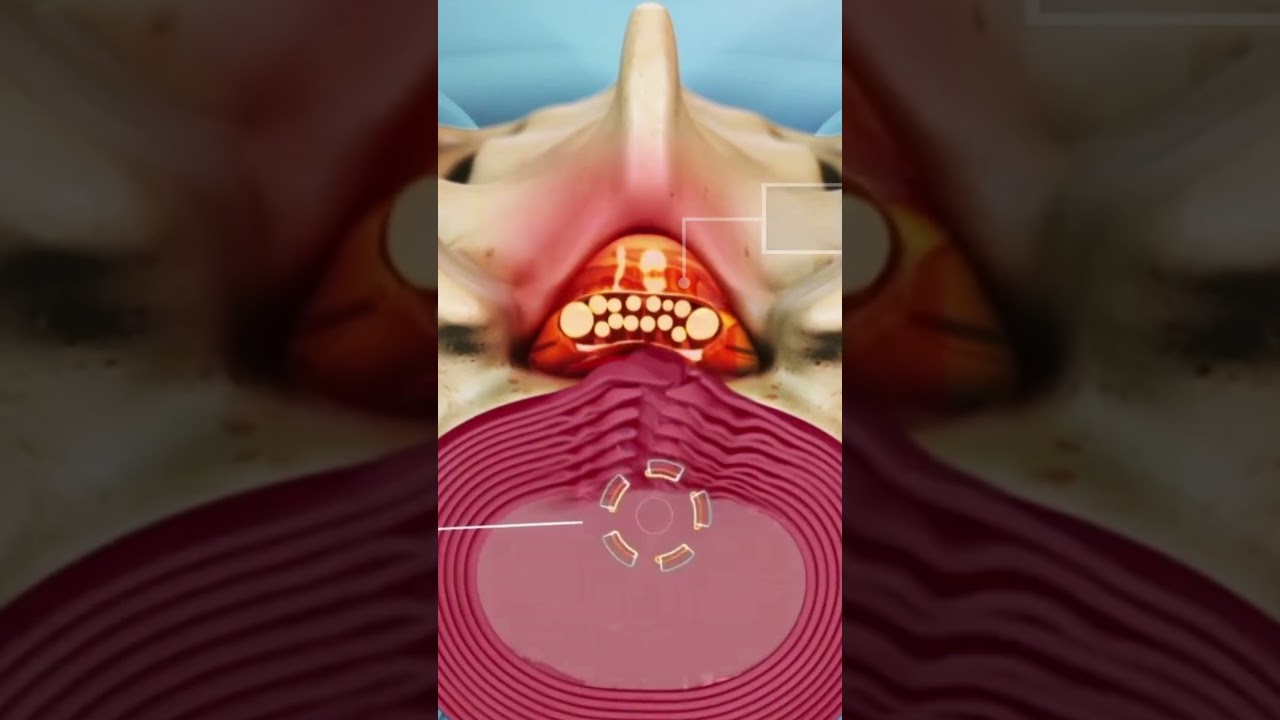 Compression of the Cauda Equina in the Lumbar Spine