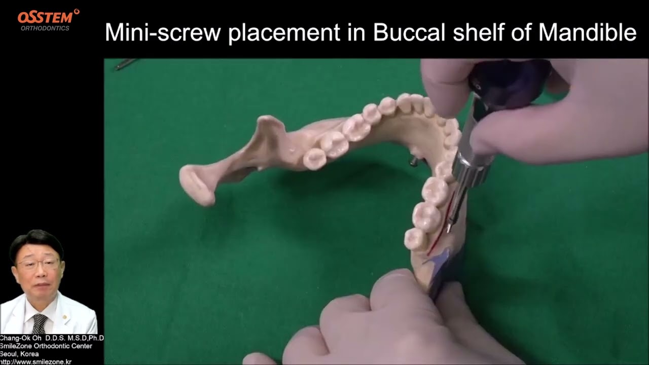 8. Щечная полка. Когда и как использовать ортодонтический винт