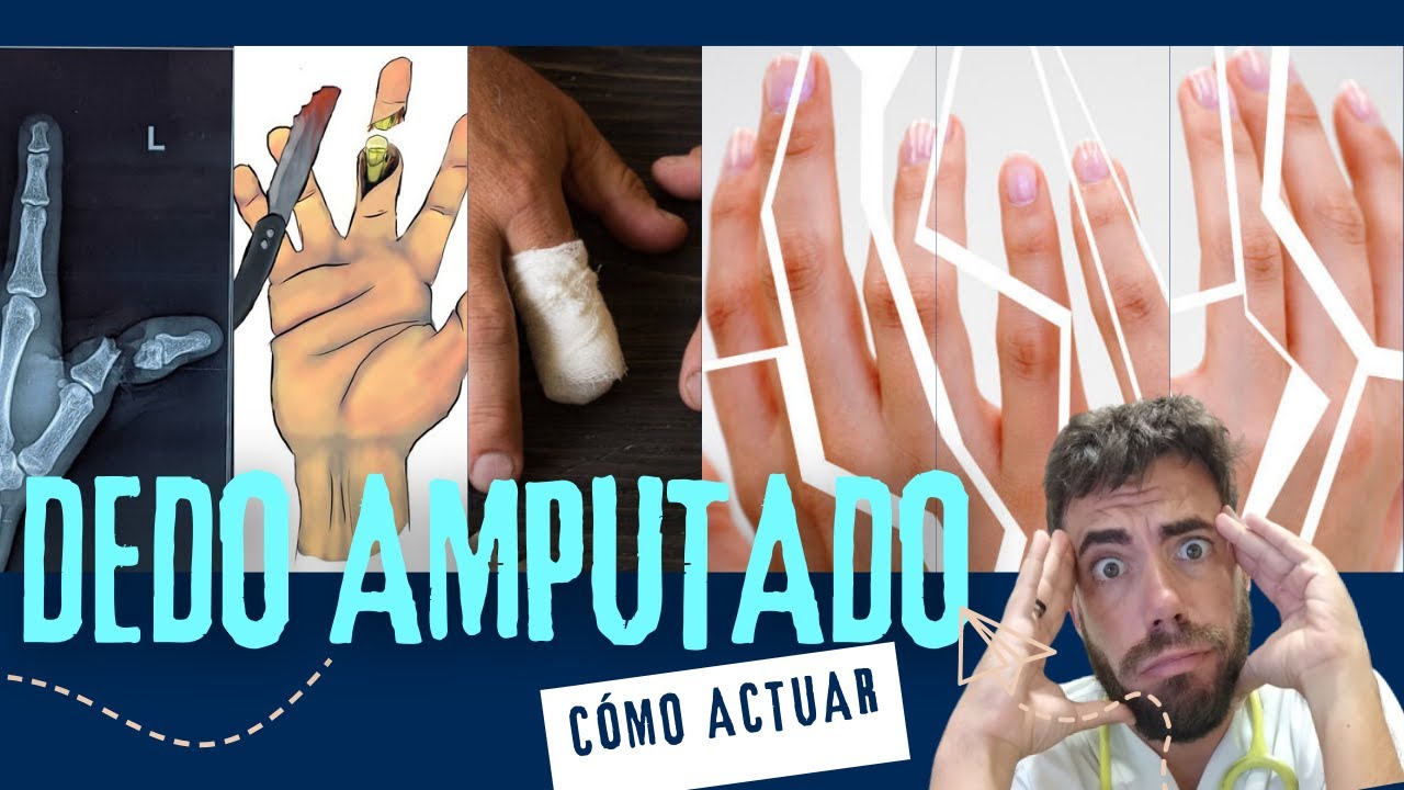 ¿Qué hacer en una AMPUTACIÓN de un dedo?🤟🏻 PRIMEROS AUXILIOS 🚨