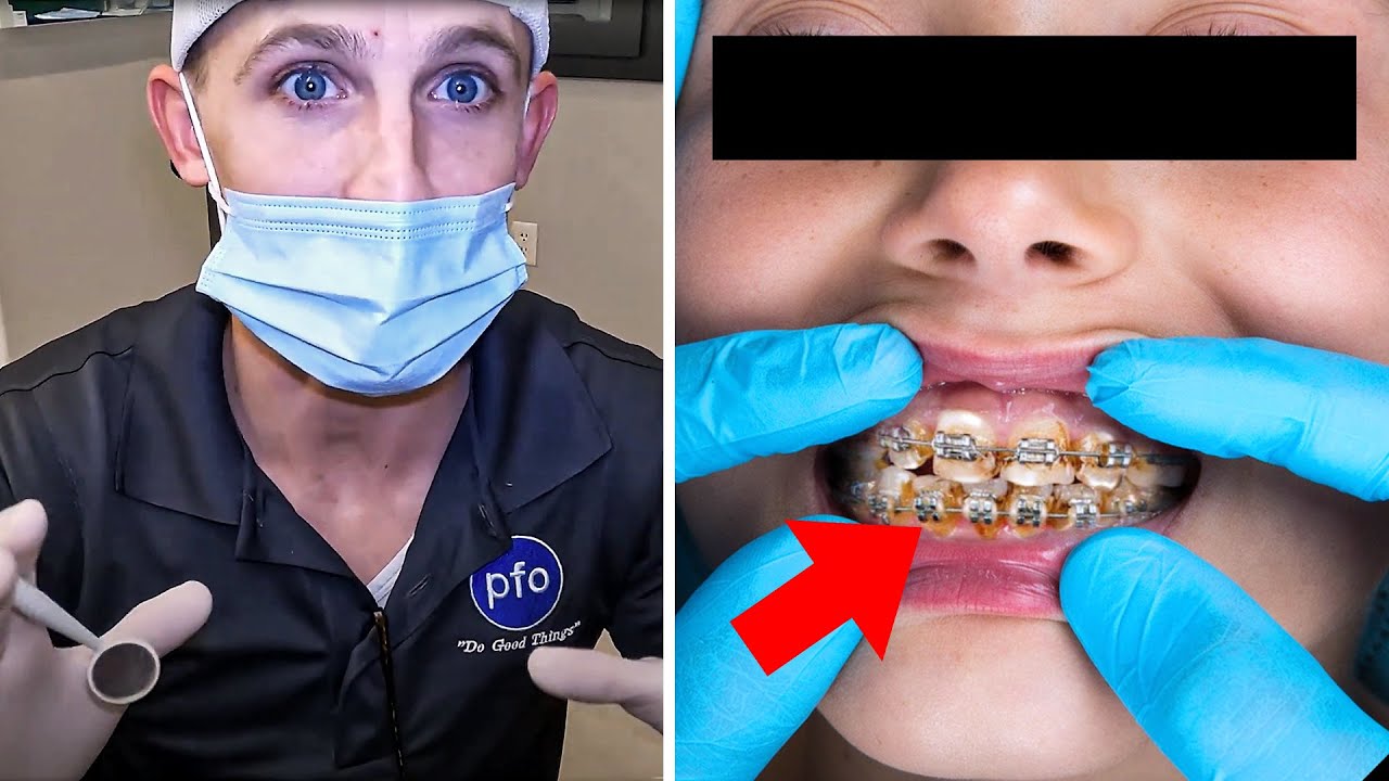 Do Braces Cause CAVITIES? the truth…. Orthodontist explains