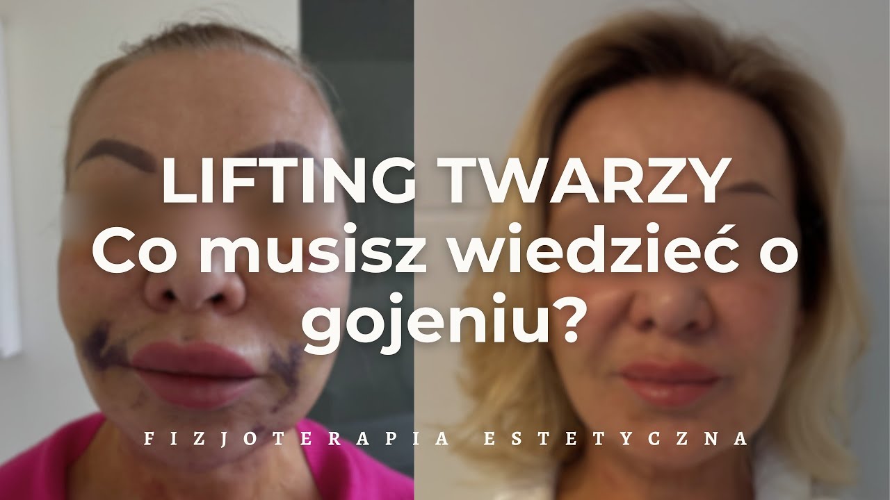 LIFTING TWARZY | Co musisz wiedzieć? | Dr n. med. Jacek Szwedo