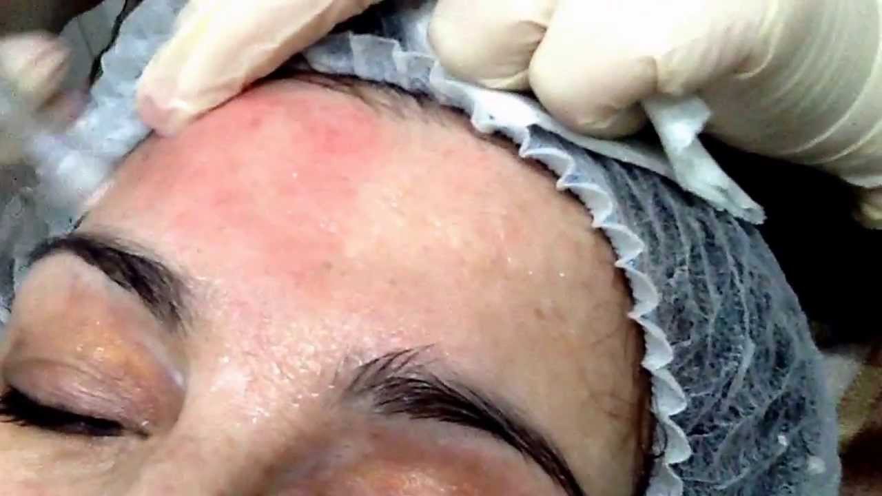 eDS Dermastamp / Dermaroller Skin Rejuvenation Treatment - Outline Clinic Droitwich UK