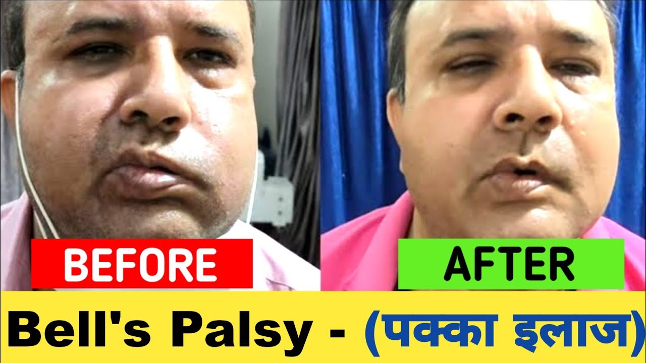 Bells Palsy Treatment in Hindi | चेहरे का लकवा कैसे ठीक करे | Physiotherapy Exercise for Bells Palsy