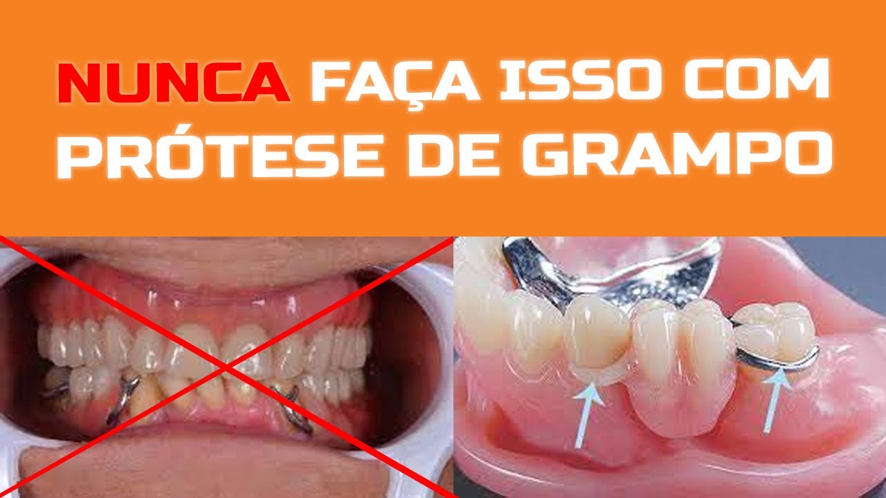 Nunca faça isso com sua prótese de grampo (metal)