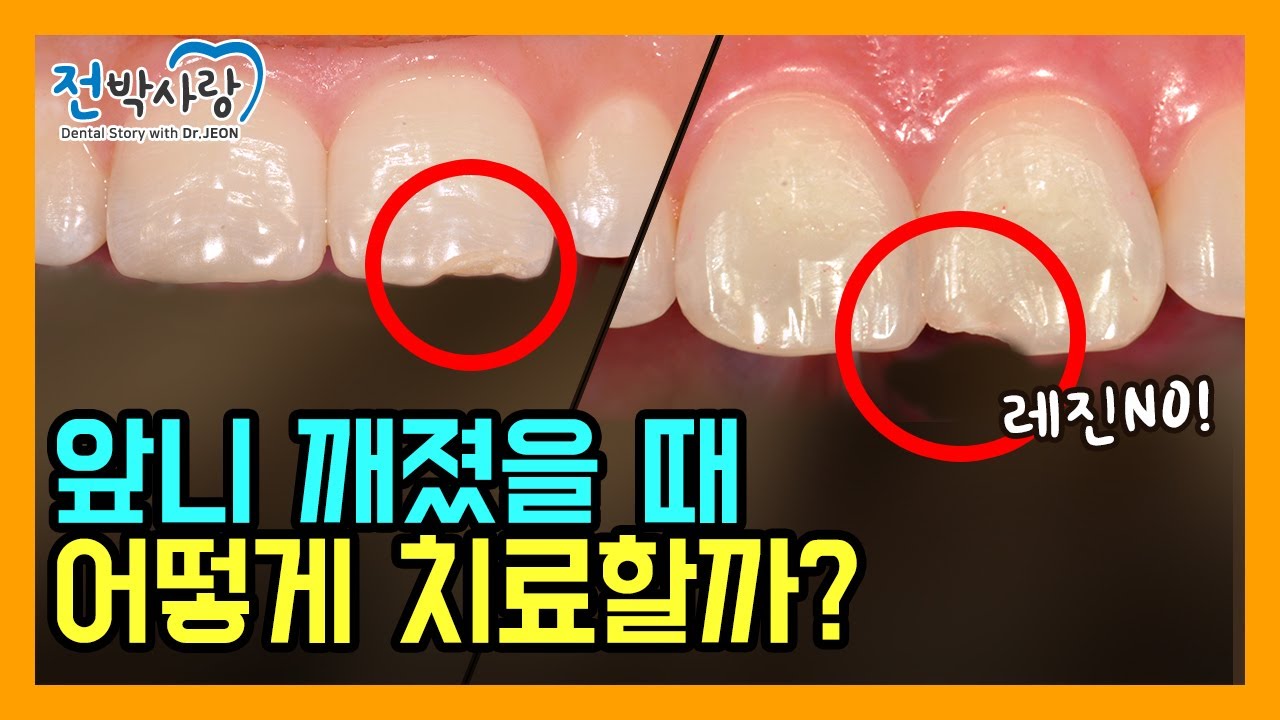 4-14.레진 치료할까? 그냥둘까? 어떻게 할까요? 깨진 앞니?(치아파절)✅