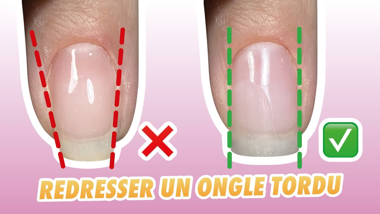 ONGLE TORDU 😱 COMMENT FAIRE pour REDRESSER un ongle COMPLÈTEMENT DEVIÉ 🤫