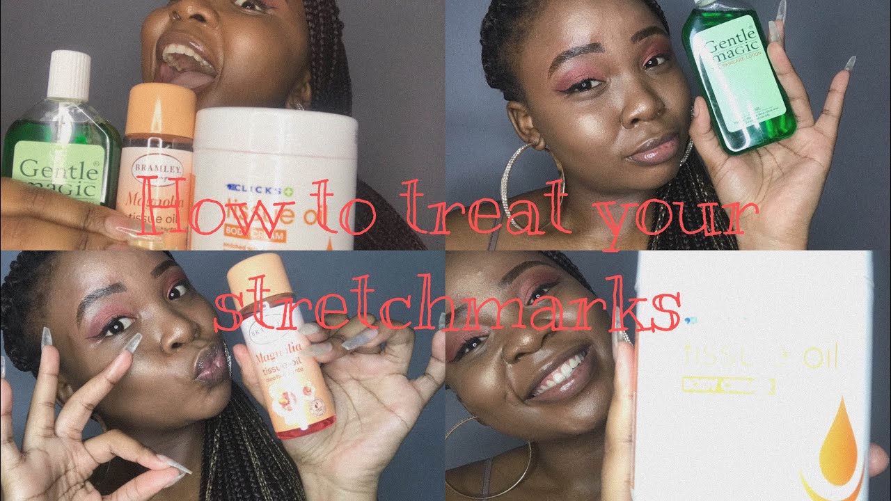 Skin diaries | How I treat my stretchmarks | RoadTo150 | South African YouTuber