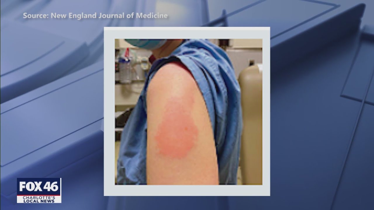 ‘Moderna arm’: Some report itchy rash after getting Moderna vaccine