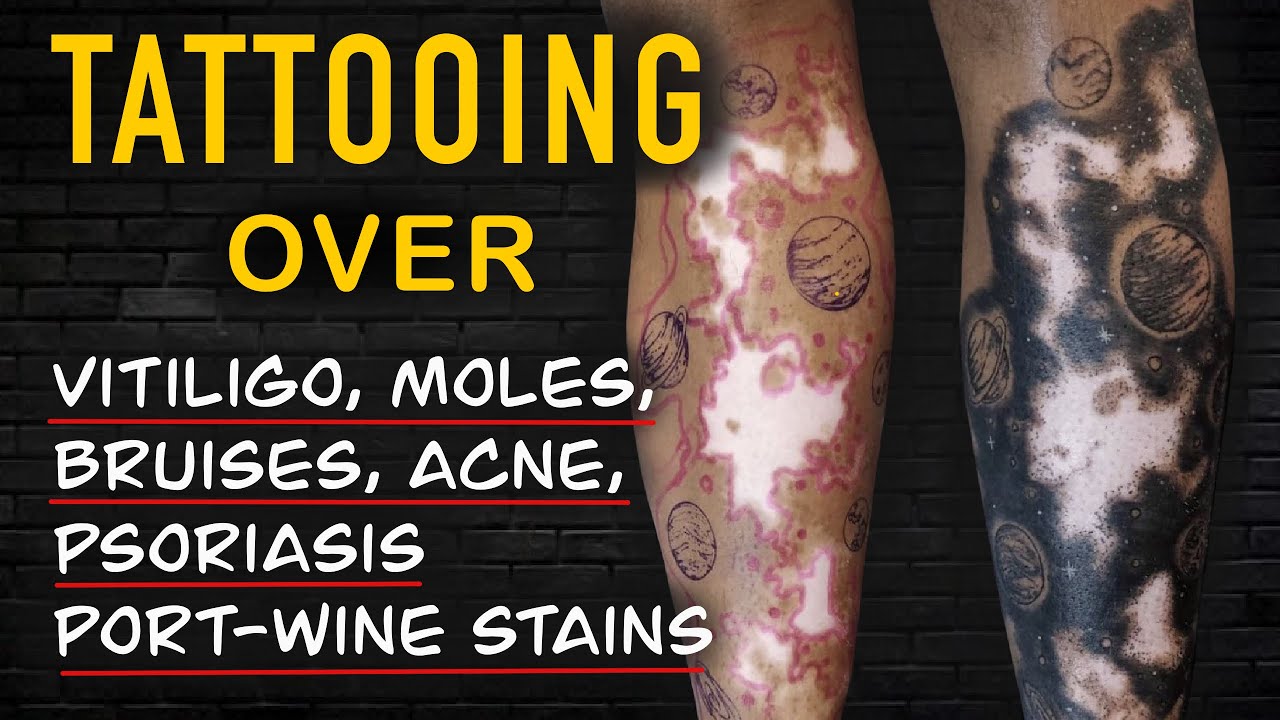 What Happens If You Tattoo Over Vitiligo, Moles Or Acne?