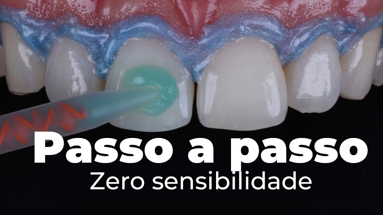 PASSO A PASSO! Como fazer um Clareamento realmente Zero Sensibilidade