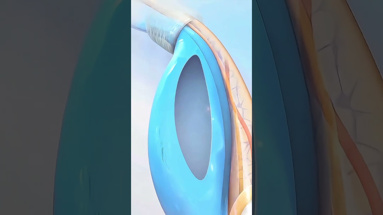 Baby Hernia Explained (3D Animation) #medicaleducation #healthcare #fyp