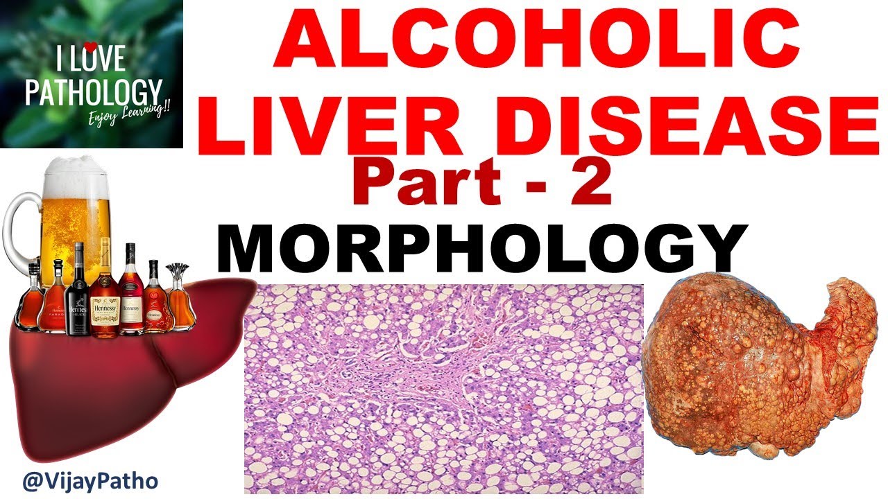 ALCOHOLIC LIVER DISEASE: Part 2. Morphology, Clinical Features & Complications including cirrhosis