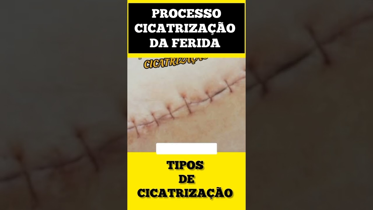 CICATRIZA&Ccedil;&Atilde;O POR PRIMEIRA INTEN&Ccedil;&Atilde;O  #shorts #feridas #feridasecurativos #enfermagem