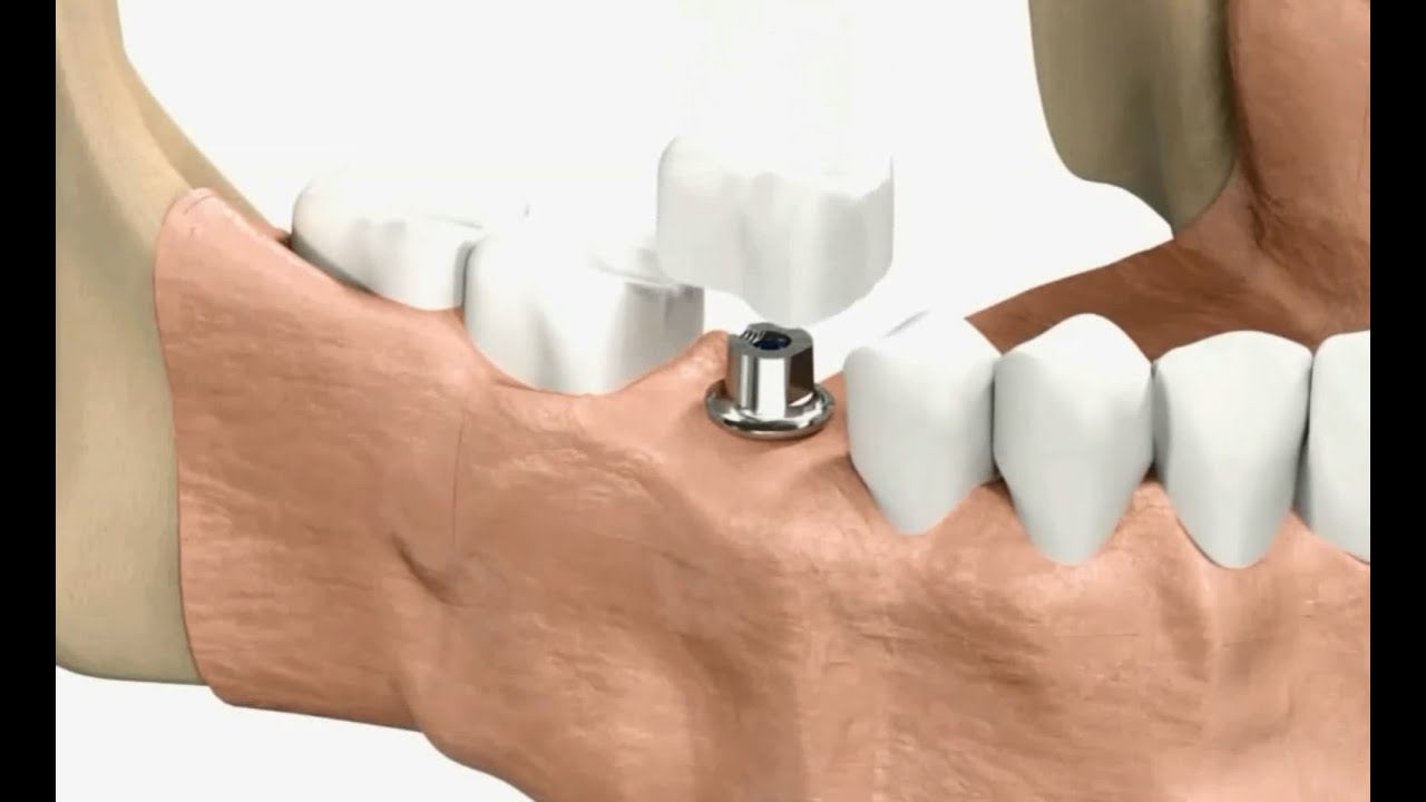Fogkorona készítése implantátumra